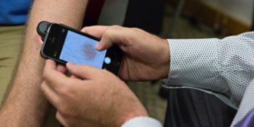 Aplikacja na iPhone’a bardzo skuteczna w diagnozowaniu czerniaka